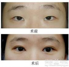 双眼皮手术费用全解析,割双眼皮手术价格与双眼皮手术费用详解