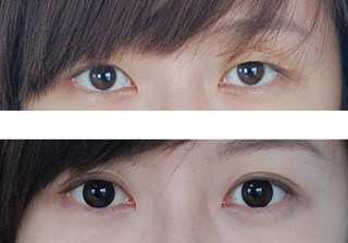 双眼皮手术费用全解析,割双眼皮手术价格与双眼皮手术费用详解