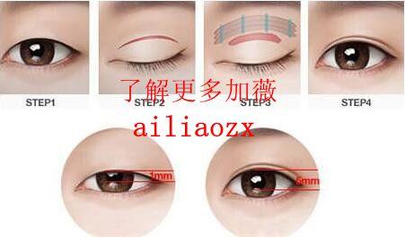 双眼皮手术费用全解析,割双眼皮手术价格与双眼皮手术费用详解